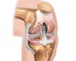 Ранняя стадия артрита коленного сустава