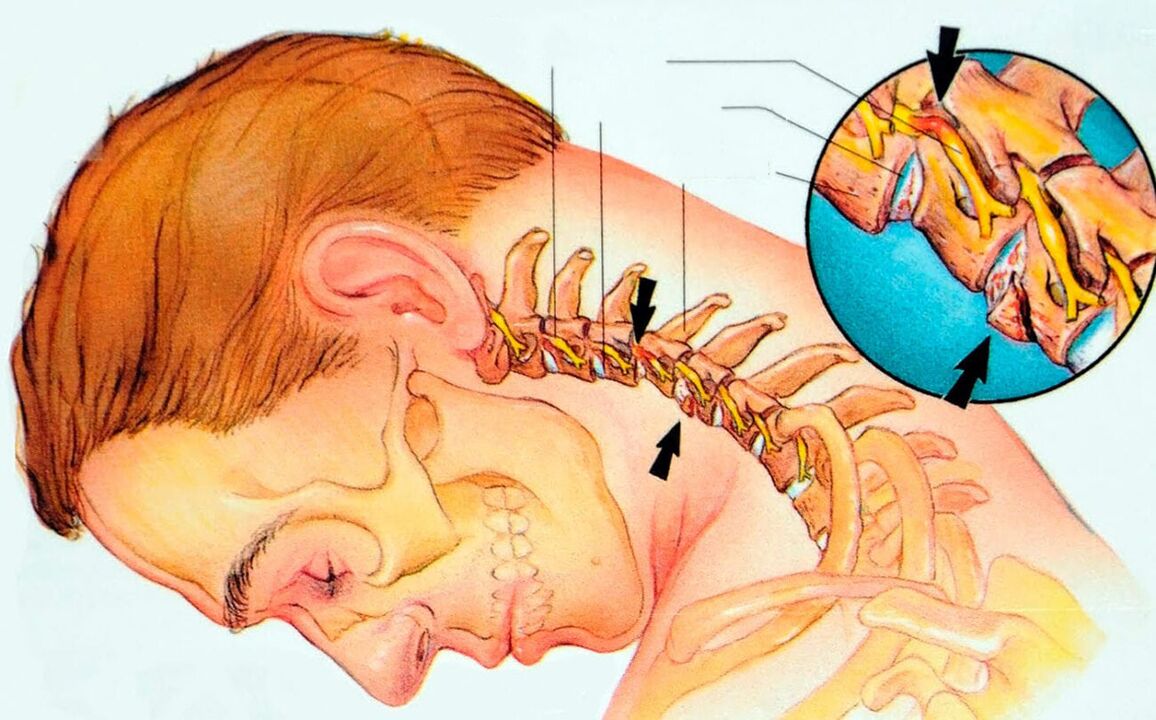 Что такое борьба остеохондральной шейки матки